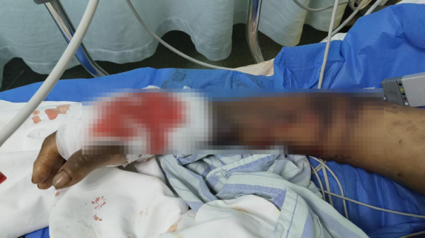 鼎宝融 四川八旬老人被毒蛇咬伤抢救脱险：警方调查养蛇户，当地悬赏万元捕蛇